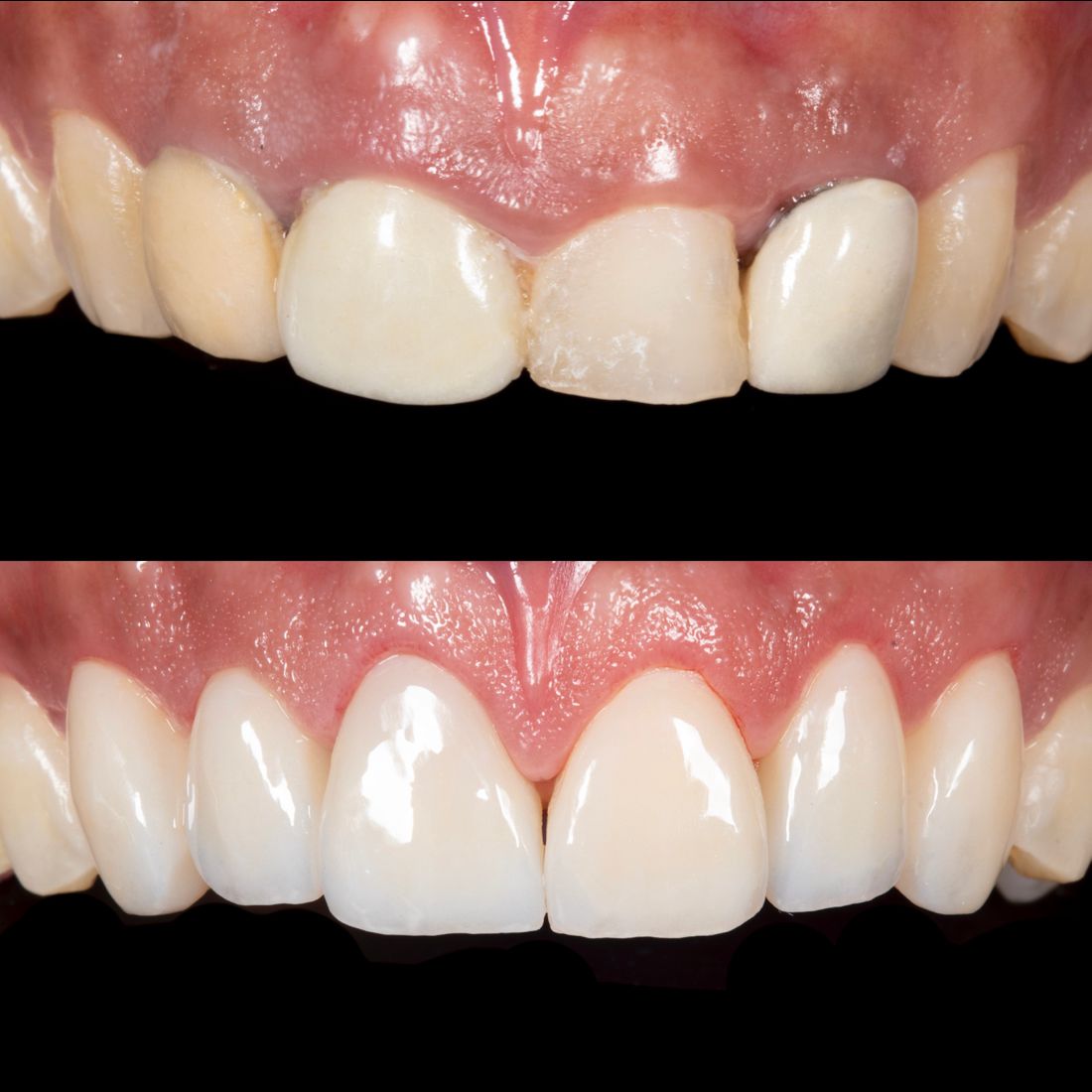 Smile Design in Punta cana